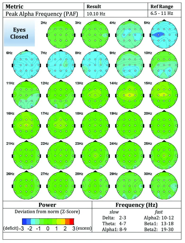 Figure B1 Pre-treatment brain maps