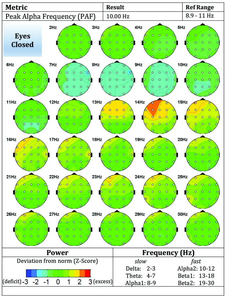 Figure B2 Post-treatment brain map