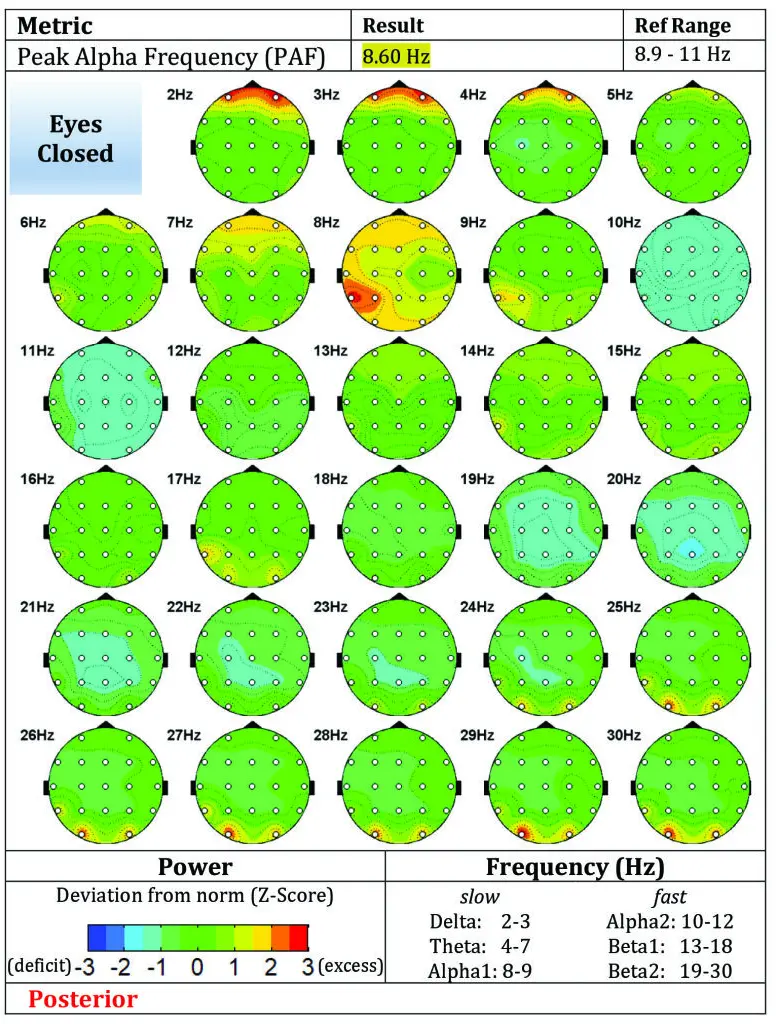 Post-Treatment Eyes Closed qEEG Brain Map