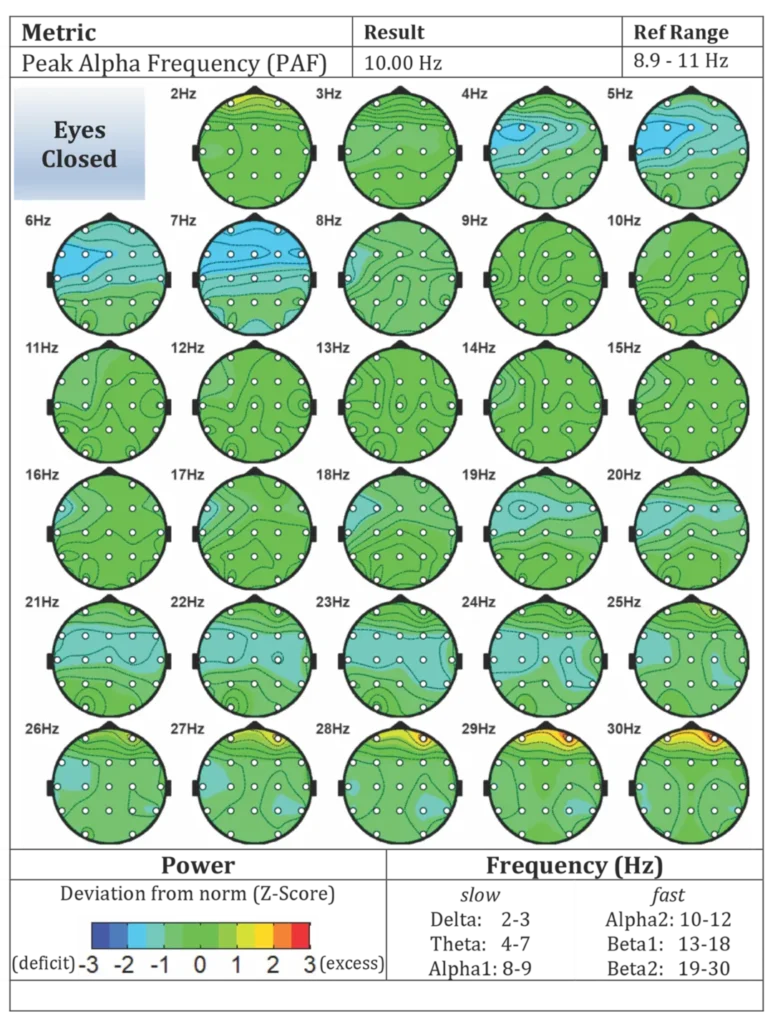 Post-treatment brain maps