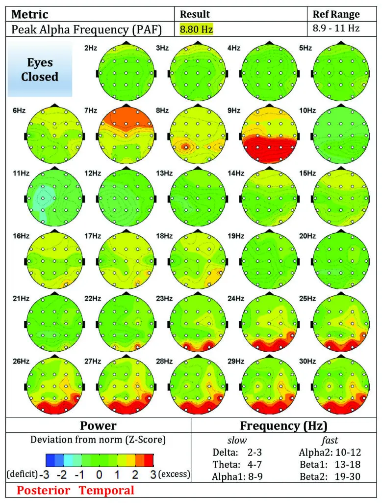 Pre-Treatment Eyes Closed qEEG Brain Map