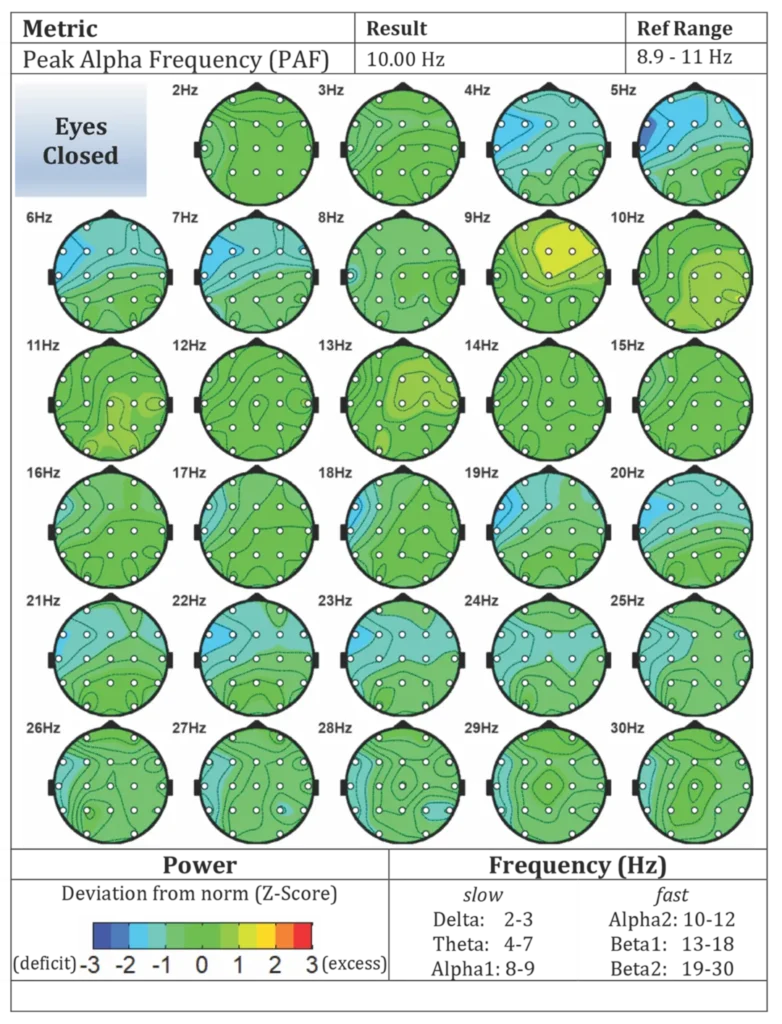 Pre-treatment brain maps